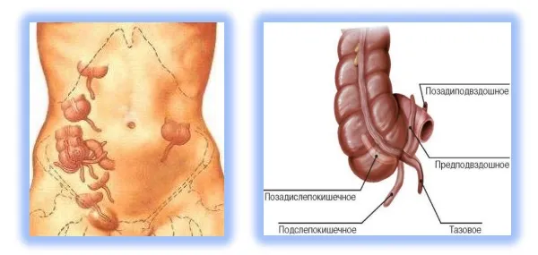 Аппендицит схема расположения