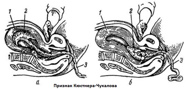 Признаки отделения плаценты кюстнера-чукалова. Признак кюстнера чукалова кюстнера. Признак отделения последа альфельда. Признак кюстнера чукалова. Признак отделения последа кюстнера-чукалова.